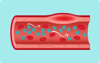 Illustration of how high levels of chylomicrons are thought to restrict blood flow and induce inflammation in blood vessels.